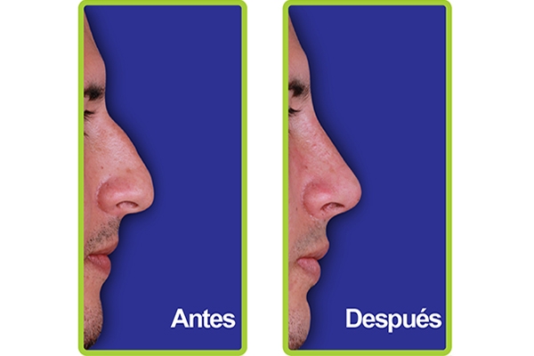 nariz_casos_4