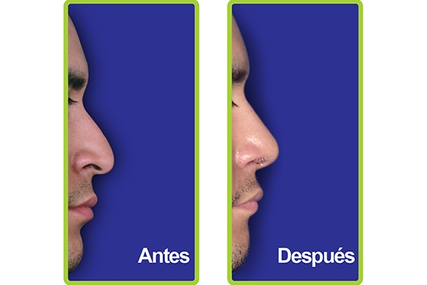 nariz_casos_6
