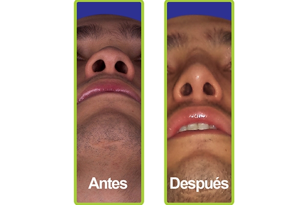 nariz_casos_8